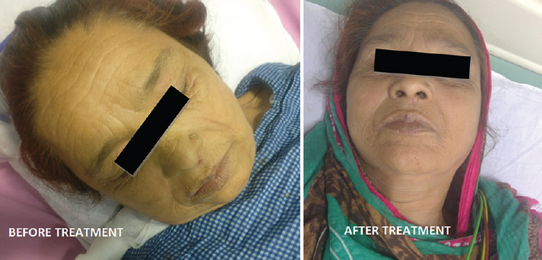 Characteristic carotenaemia, myxoedemic facies before treatment, with remarkable disappearance following treatment on five-month follow up.